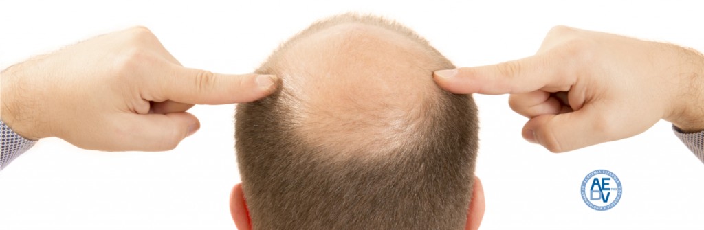 Una solución adaptada a cada tipo de alopecia