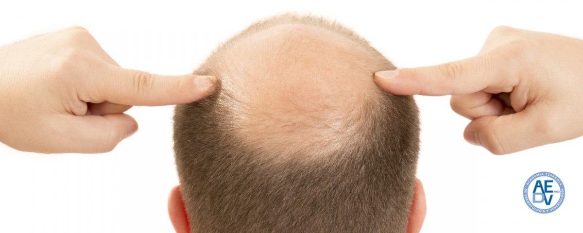 Una solución adaptada a tipo de alopecia - Academia Española de Dermatología y