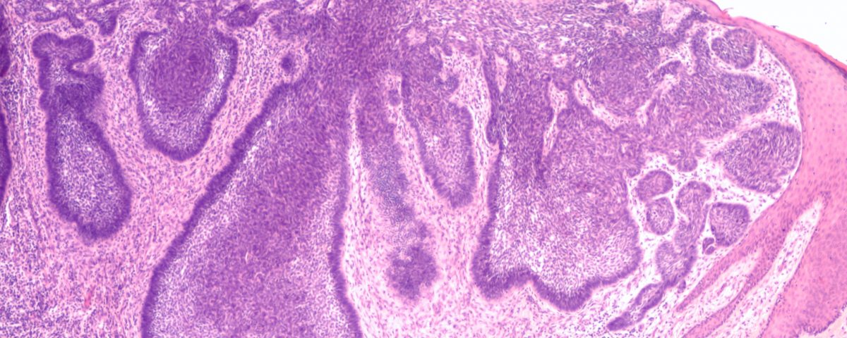 Imagen de una biopsia de un carcinoma basocelular.