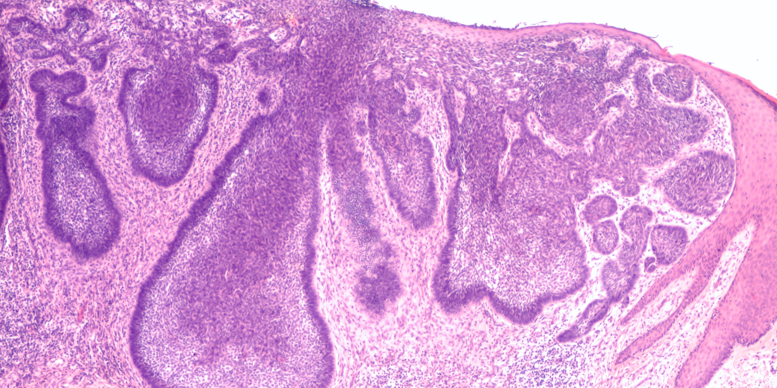 Imagen de una biopsia de un carcinoma basocelular.